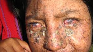 Xeroderma pigmentosum (xp) was first described in 1874 by hebra and kaposi. Xeroderma Pigmentosum Pictures Symptoms Treatment And More