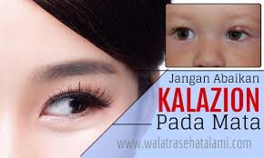 Jangan Abaikan Kalazion Pada Mata Segera Atasi Dengan Obat Alami Kalazion Pada Mata Kalazion Merupakan Benjolan Pada Kelop Obat Alami Mata Kesehatan Alami