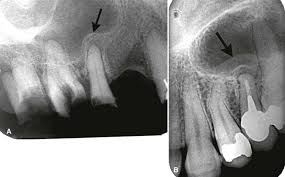 Image result for periostitis
