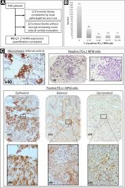 Your sole focus should be on your family and medical treatment, so we will do everything we can to make the. Shorter Survival In Malignant Pleural Mesothelioma Patients With High Pd L1 Expression Associated With Sarcomatoid Or Biphasic Histology Subtype A Series Of 214 Cases From The Bio Maps Cohort Clinical Lung Cancer