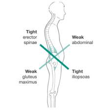 Treatment Of Lower Crossed Syndrome West Suburban Pain Relief