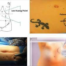 Keywords laparoscopy.palmers point background response letter to article: A D Depiction Of The Alternative Entry Site For The Large Uterus Download Scientific Diagram