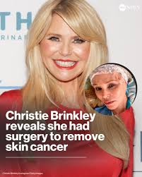 Actress and model Christie Brinkley revealed she has been diagnosed with  basal cell carcinoma, a common form of skin cancer, in an Instagram post  featuring photos of her recovery from surgery.