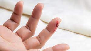 287 :215 doi you are going to email the following finger sepsis. Blutvergiftung Sepsis Erkennen Und Schnell Behandeln Ndr De Ratgeber Gesundheit