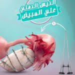 منظار البطن يزيل الكيس الدهني على المبيض 4 shrimp meat