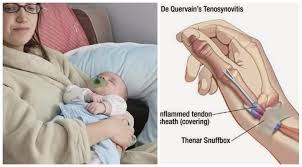 Sakit Pergelangan Tangan Ibu Jari 5 Perkara Tentang Dequervain S Tenosynovitis Mama Perlu Tahu