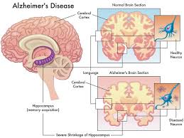 Det er derimod ikke normalt at glemme, hvor. Acetylkolin Alzheimers