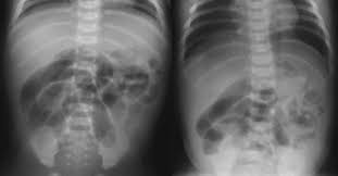 Image result for Adynamic Ileus