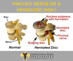 How to know if you have a pinched nerve. Is My Pain Caused By A Pinched Nerve Or A Herniated Disk Louisiana Pain Specialist