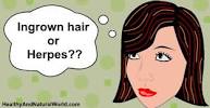 Ingrown Hair Or Std