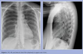 Image result for Pneumothorax