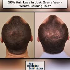 How common is hair loss in women? 50 Hair Loss In Just Over A Year What S Causing This Hair Loss 50 Hair Pattern Baldness