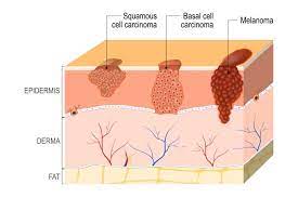 Care guide for squamous cell carcinoma. Cutaneous Squamous Cell Carcinoma Cscc Ausmed