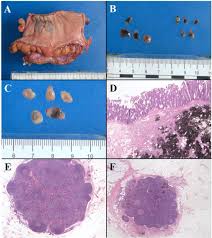 These articles are sourced to a single report that finds certain tattoo inks contain chemicals. Preoperative Endoscopic Tattooing Technique Improved Lymph Node Retrieval In Rectal Cancer Patients Receiving Neoadjuvant Concurrent Chemoradiotherapy Journal Of Clinical Pathology