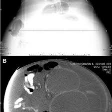 Types of birthmarks include cafe au lait marks, mongolian spots, strawberry marks. Pdf Primary Intestinal Lymphangiectasia With Massive Abdominal Lymphatic Malformation Requiring Surgical Debulking