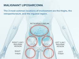 Image result for Liposarcoma