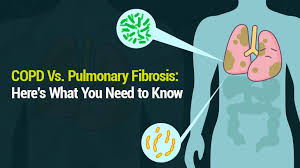 Risk factors for chronic bronchitis include continuous attacks of acute bronchitis, weak immune system, irritants, and polluted air. Lung Health Institute Copd Vs Pulmonary Fibrosis