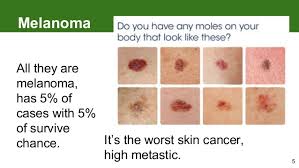 A sign is something that can be observed by another person, such as a change in skin color or wheezing. Melanoma How To Detect Skin Cancer
