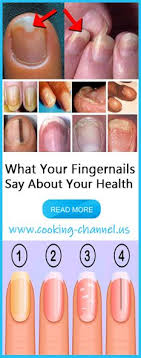 16 Best Fingernail Health Images In 2019 Fingernail Health