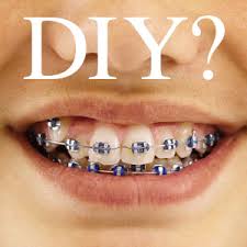 How to whiten teeth with braces diy. The Dangers Of Diy Braces Image Dental