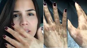 Pérola Faria sofre queimaduras nas mãos e faz alerta para os fãs