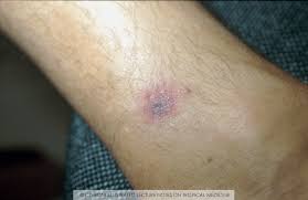 Image result for Rickettsialpox