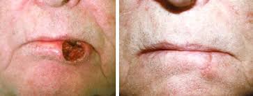 Melanoma skin cancer has a rapid growth rate, which is what makes it so dangerous; Skin Cancer Treatment Roanoke Va