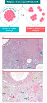 Says shelly fisher, 61, of philadelphia, who was. Neoadjuvant Therapy In Early Breast Cancer Treatment Considerations And Common Debates In Practice Sciencedirect