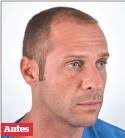 The album was released in 2000. A Moda Dos Implantes Capilares Pressreader