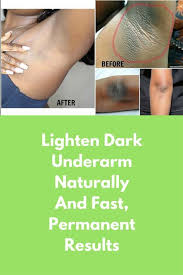 Lighten Dark Underarm Naturally And Fast Permanent Results Ingredients Required Are Baking Soda Le Baking Soda And Lemon Dark Underarms Baking Soda Underarm