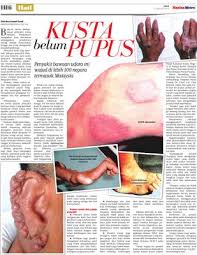 Situasi di malaysia juga mengindikasikan hal yang sama, yaitu kejadian kusta lebih banyak pada etnik china dibandingkan etnik melayu atau india. Kusta Belum Pupus Klik