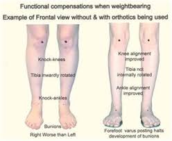 Bow Legs Correction Knock Knee Fix Effective Program For Shaping Your Legs Bow Legged Correction Bow Legged Knock Knees