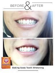 The soda should ideally not be used too frequently since it can damage the enamel as a result of frequent use. How To Whiten Your Teeth With Baking Soda Arxiusarquitectura