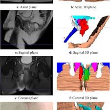 Image result for Ischiorectal Abscess