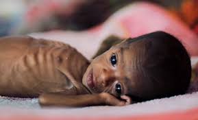 Why India remains malnourished
