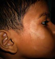Pityriasis alba is a common skin disorder in children (90%) and young adults. Pityriasis Alba Causes What Pityriasis Alba Looks Like Diagnosis Treatment