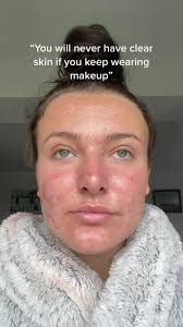 Busting Acne Myths: Makeup & Skincare