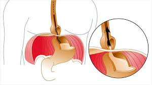 connecting the dots understanding the link between hiatal