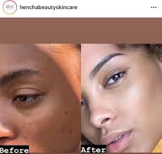 Get the skin you've always desired today with www.HenchaBeautySkincare.com