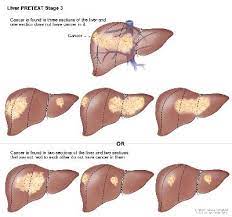 A small number of children have leukemia that has already spread to the brain and spinal cord when it is first found. Liver Cancer In Children Causes Symptoms Diagnosis And Treatment St Louis Childrens Hospital