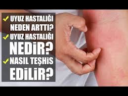 Uyuz Belirtileri Ve Uyuz Tedavisi Youtube