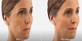 In a facelift, they take out a margin of skin in front of the ears and pull the skin back tighter. Best Jowls Treatment Newcastle Treatment Rt Aesthetics