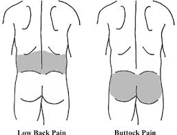 Osteoarthritis of the back can result in the breakdown of the protective and cushioning cartilage of the spine. The Schematic Diagram Explaining The Areas Of Low Back Pain And Buttock Download Scientific Diagram