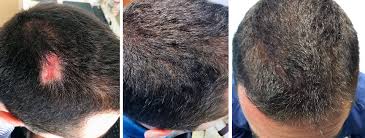 Questo metodo offre l'opportunità di sottoporsi a una . Trapianto Di Capelli Fue Tecnica Fue Barba Capelli Midscalp Tricogenesis