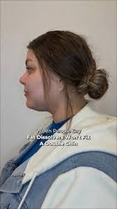 When People Say Fat Dissolvers Won’t Fix A Double Chin👀, Many people  believe the only way to treat a double chin is with surgery but that’s not  true., Fat dissolving injections target and break down ...