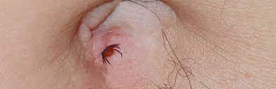 Schätzungsweise fünf bis 35 prozent der zecken sind mit borrelien infiziert. Eine Zecke Im Bauchnabel Der Fall