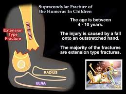 Periosteal disruption with instability in both flexion and extension Supracondylar Fracture Of The Humerus In Children Everything You Need To Know Dr Nabil Ebraheim Youtube