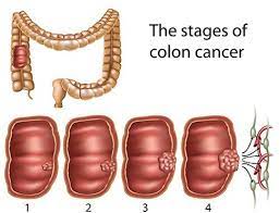 The rates of colon cancer in people younger than 50 have been increasing, but doctors aren't sure why. Colon Cancer Stages Types And Treatments Of The Disease