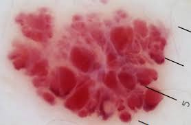 Image result for Dermoscopy