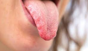 Maybe you would like to learn more about one of these? Ø£ÙØ¶Ù„ Ø§Ù„Ø£Ø¯ÙˆÙŠØ© Ù„Ø¹Ù„Ø§Ø¬ ÙØ·Ø±ÙŠØ§Øª Ø§Ù„Ù„Ø³Ø§Ù† ÙˆØ§Ù„ÙˆÙ‚Ø§ÙŠØ© Ù…Ù†Ù‡Ø§ Ù…Ø³ØªØ´ÙÙŠØ§Øª Ù…ØºØ±Ø¨ÙŠ